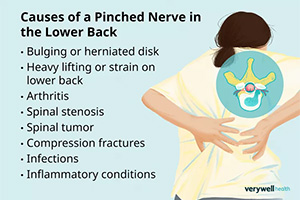 Pinched Nerve in Lower Back: What to Do and Avoid